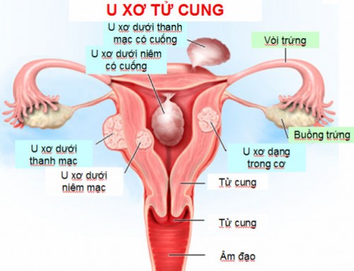 Giải đáp tất tần tật bệnh án phụ khoa u xơ tử cung ở nữ giới