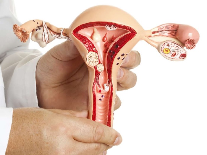 U xơ tử cung là căn bệnh thường gặp của phụ nữ Khi nào cần phẫu thuật u xơ tử cung