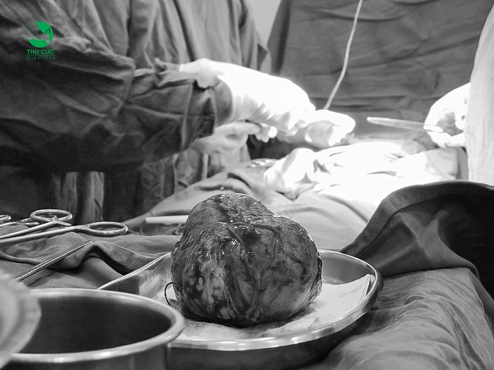 Một u xơ tử cung được thực hiện phẫu thuật bóc tách tại BV ĐKQT Thu Cúc
