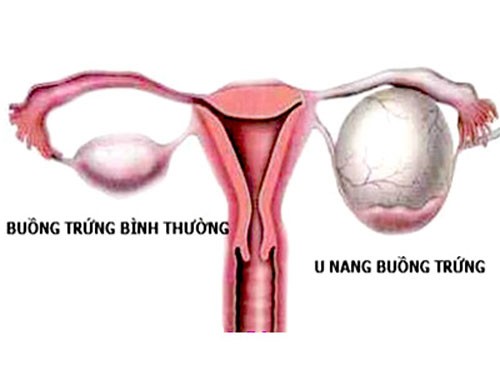U nang buồng trứng là hiện tượng trên buồng trứng của nữ giới xuất hiện một khối u bất thường.