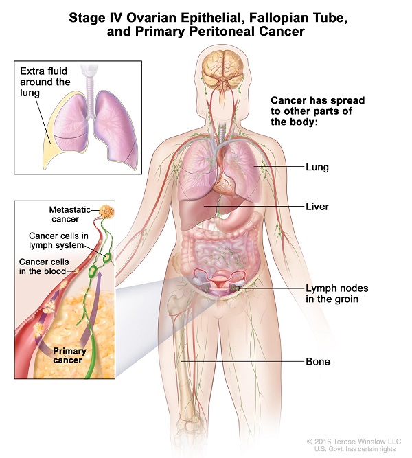 Ung thư buồng trứng giai đoạn cuối có thể di căn đến các cơ quan như phổi, xương, gan...