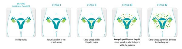 Các giai đoạn ung thư buồng trứng