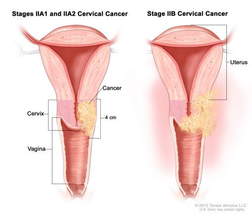 Phương pháp xạ trị được sử dụng trong điều trị ung thư cổ tử cung giai đoạn 2 là gì?
