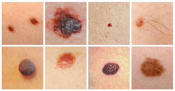 Ung thư da là bệnh nguy hiểm nếu không được phát hiện và điều trị kịp thời