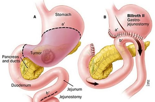 Phẫu thuật mổ ung thư dạ dày là phương pháp hiệu quả giúp cải thiện tình trạng bệnh