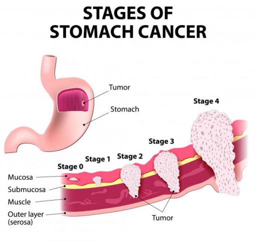 Ung thư dạ dày giai đoạn 3 được xếp vào giai đoạn nào của bệnh?
