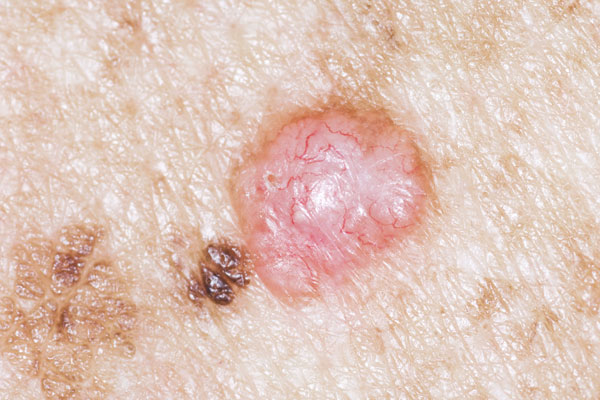 Vết loét trên da lâu lành có thể là dấu hiệu cảnh báo ung thư da