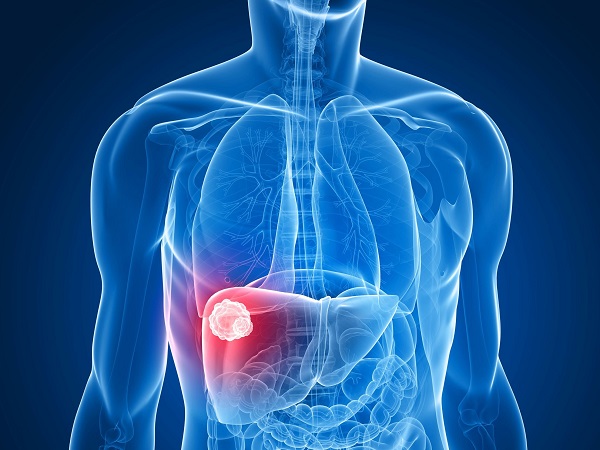Ung thư gan nếu không được phát hiện, điều trị sớm có thể di căn rộng đến các cơ quan ở xa