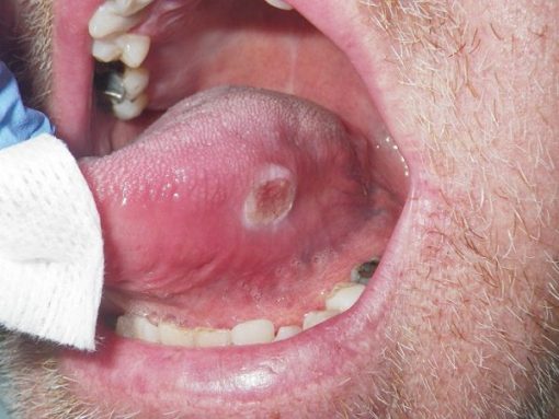 Những triệu chứng của ung thư lưỡi di căn hạch cổ là gì?
