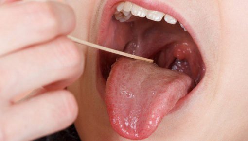 Nguồn gốc của sự phát triển ung thư đáy lưỡi?

