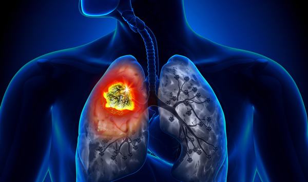 Người trẻ tuổi có nguy cơ cao mắc ung thư phổi