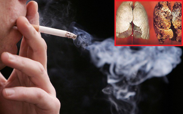 Ung thư phổi có nguyên nhân chủ yếu là do khói thuốc lá