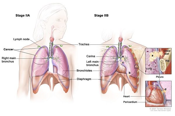 Tổng hợp】Ung thư phổi giai đoạn 2 | TCI Hospital