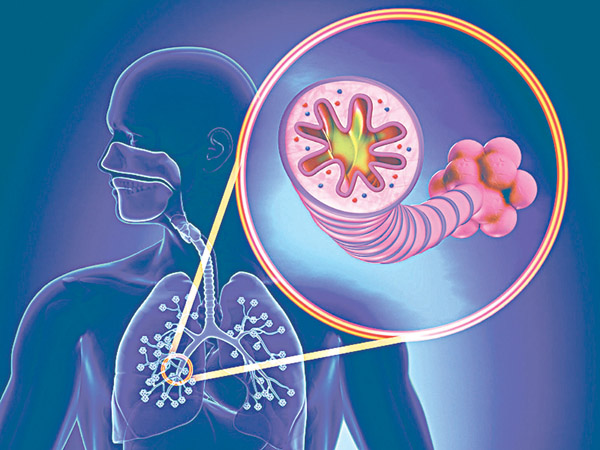 Bệnh ung thư phổi cũng xuất hiện ở những người bị bệnh phổi mạn tính