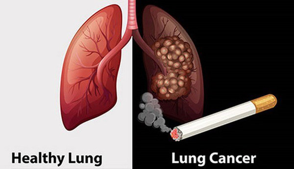 Những người hút thuốc lá lâu năm có nguy cơ cao mắc ung thư phổi