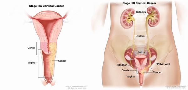 Ung thư tử cung là bệnh ung thư nguy hiểm thường gặp ở phụ nữ trên 40 tuổi