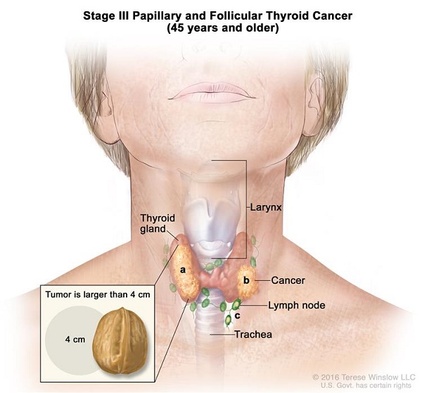 Triệu chứng và cách điều trị cho bệnh ung thư tuyến giáp giai đoạn 3 hiệu quả và an toàn
