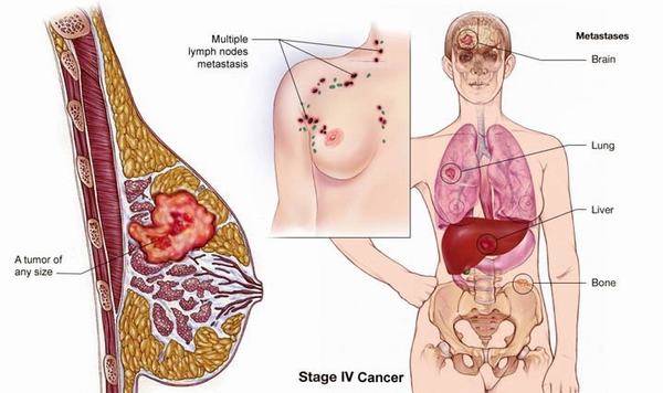 Ung thư vú có thể gặp ở nhiều chị em phụ nữ trên 30 tuổi, có tiền sử gia đình mắc bệnh hoặc sử dụng hormone trong thời gian dài