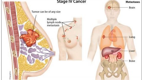 Là nữ giới, không nên bỏ qua tầm soát ung thư vú – phụ khoa
