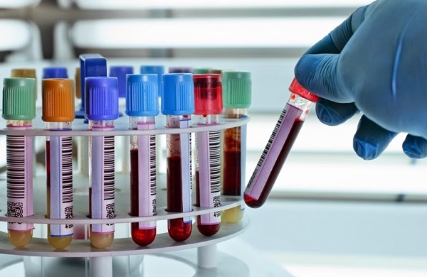 Xét nghiệm máu tìm chất chỉ điểm ung thư 