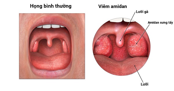 Triệu chứng của viêm amidan là gì?
