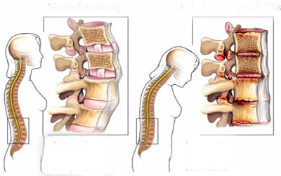Viêm Cơ Dính Khớp là gì? Cách phòng tránh bệnh như thế nào tốt nhất? Viêm cơ dính khớp ảnh hưởng nhiều tới sinh hoạt của người bệnh