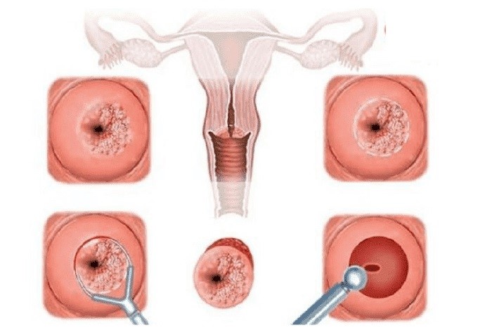 Viêm cổ tử cung là căn bệnh phụ khoa nguy hiểm