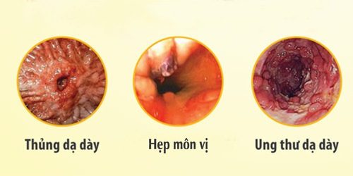 Viêm dạ dày xuất huyết cấp tính: Nguyên nhân, dấu hiệu và cách điều trị hiệu quả