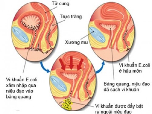 Viêm Đường Tiết Niệu Khi Mang Thai: Uống Thuốc Gì?