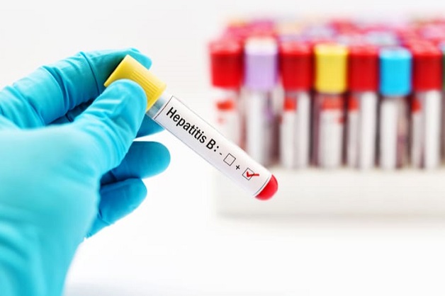 Hiện nay có nhiều loại xét nghiệm giúp chẩn đoán chính xác viêm gan B