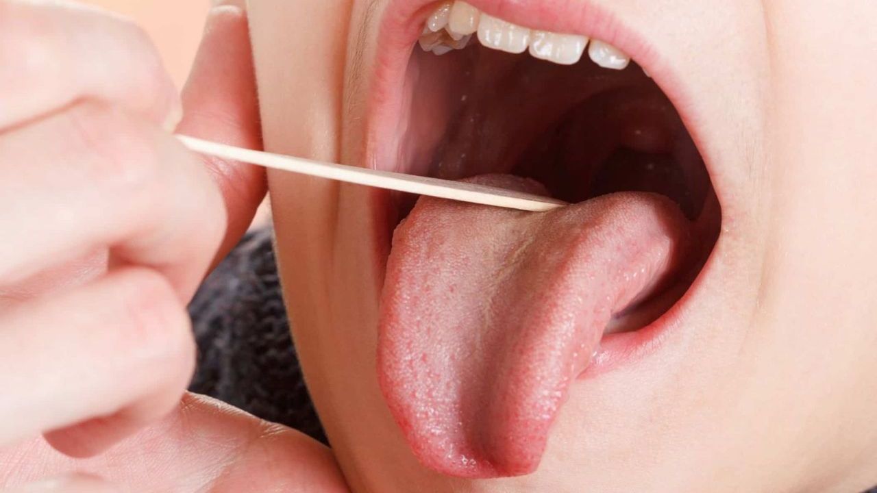 Làm thế nào để chẩn đoán viêm họng hạt?
