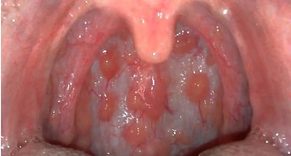 viêm họng hạt cách chữa trị