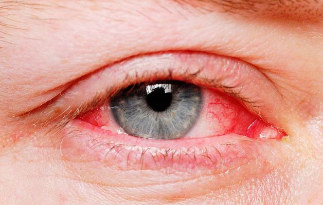 Viêm kết mạc là gì và viêm kết mạc mắt có nguy hiểm không?