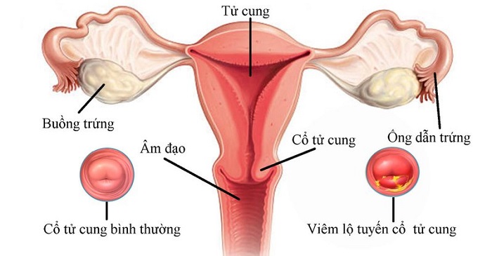 Hình ảnh của viêm lộ tuyến cổ tử cung