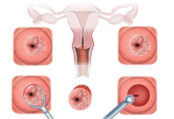 Viêm lộ tuyến cổ tử cung phổ biến trong những bệnh lý phụ khoa ở nữ giới