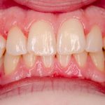 Dấu hiệu viêm nha chu cảnh báo vấn đề răng miệng