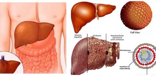 7. Những điều cần lưu ý sau điều trị viêm phúc mạc tiên phát