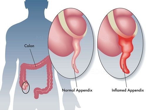 Viêm ruột thừa là hiện tượng phần ruột thừa bị viêm lên và mưng mủ, khiến cho người bệnh đau, khó chịu