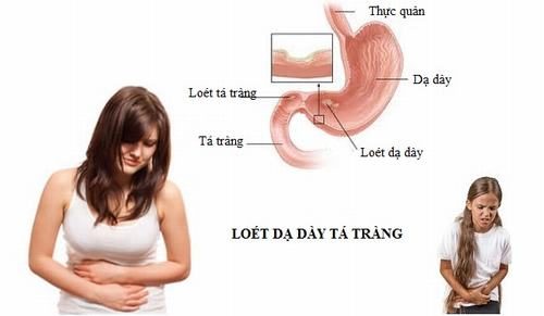 Viêm tá tràng nên ăn gì tốt là thắc mắc của nhiều người khi bị bệnh