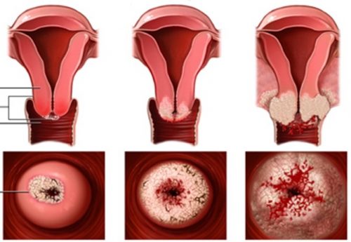 What are the symptoms and complications of viêm xung huyết cổ tử cung?