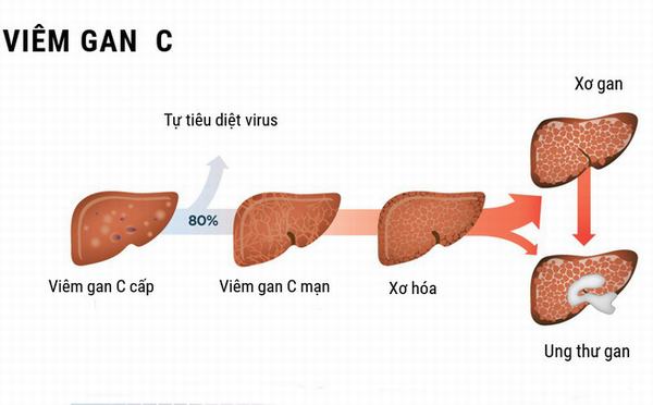 Virut viêm gan C là nguyên nhân gây bệnh viêm gan C