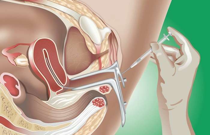 Tổng hợp kiến thức từ A đến Z về vô sinh hiếm muộn