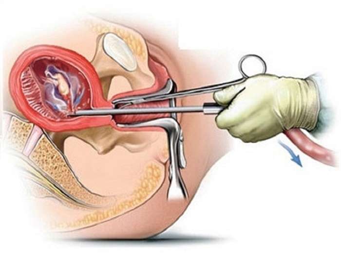 Tổng hợp kiến thức từ A đến Z về vô sinh hiếm muộn