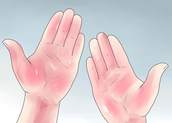 Lòng bàn tay đỏ là một trong những triệu chứng xơ gan thường gặp