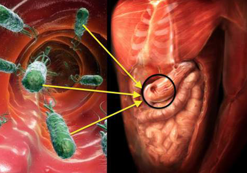 Vi khuẩn HP cư trú trong lớp niêm mạc dạ dày và có thể gây ra các bệnh ở dạ dày