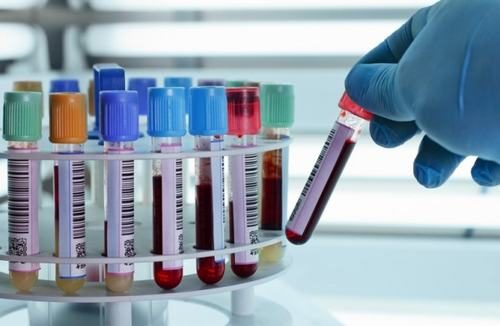 Xét nghiệm máu tìm chất chỉ điểm ung thư dạ dày giúp bác sĩ đánh giá tình trạng sức khỏe