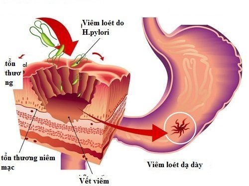 Vi khuẩn HP là nguyên nhân chính gây ra các bệnh lý ở dạ dày