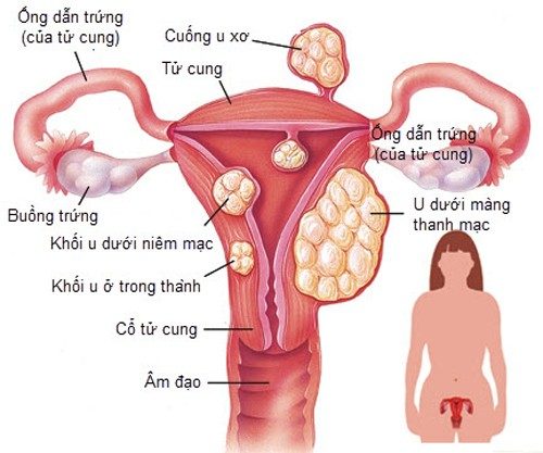 U xơ tử cung đa phần là những khối u lành tính