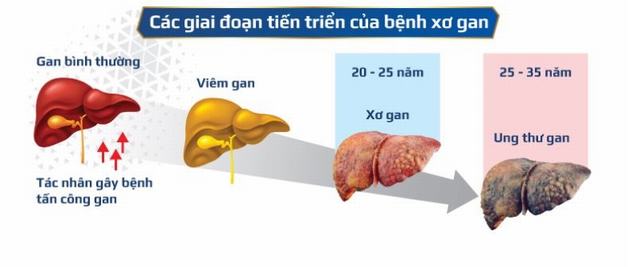 Tổng hợp 97+ hình về hình ảnh mô bệnh học xơ gan - NEC