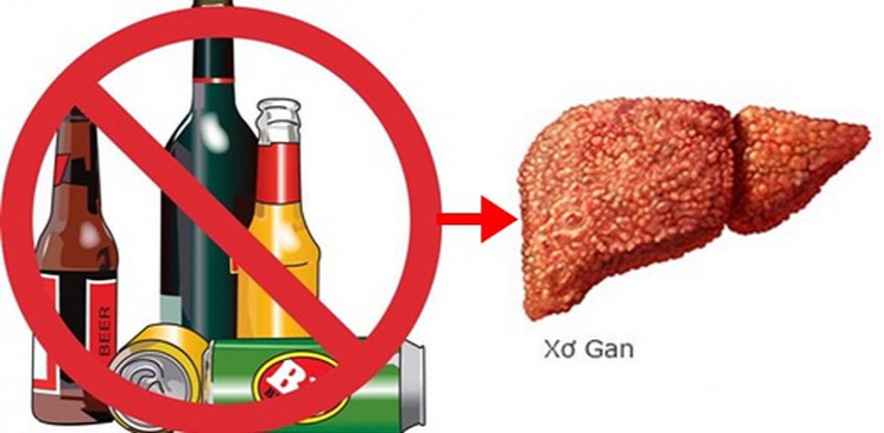 Cách chẩn đoán bệnh xơ gan rượu là gì?
